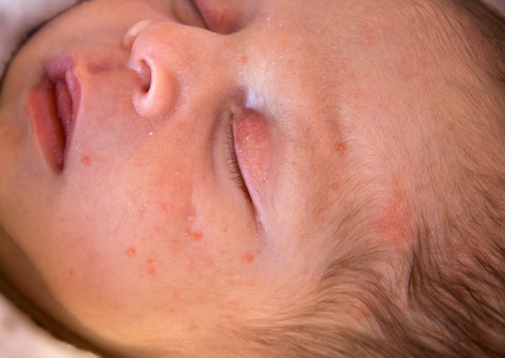 Berbagai Penyebab Bruntusan pada Bayi dan Cara Mengatasinya